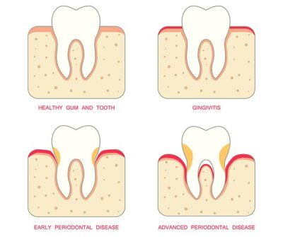 Gum disease treatment can consist of a few simple procedures to help restore damaged gums