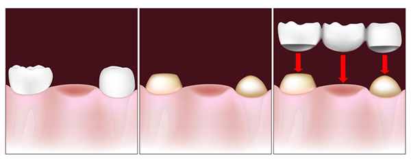 A dental bridge connects the gap where one or more teeth used to be