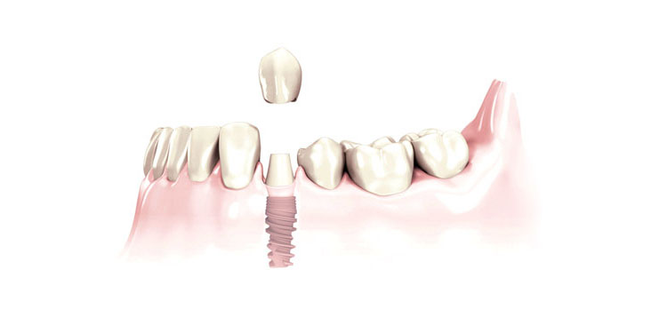 Dental Implant Procedures