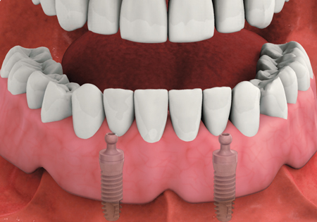 Implant-Supported Denture Graphic