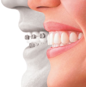 invisalign-clear-braces-for-wedding.jpg