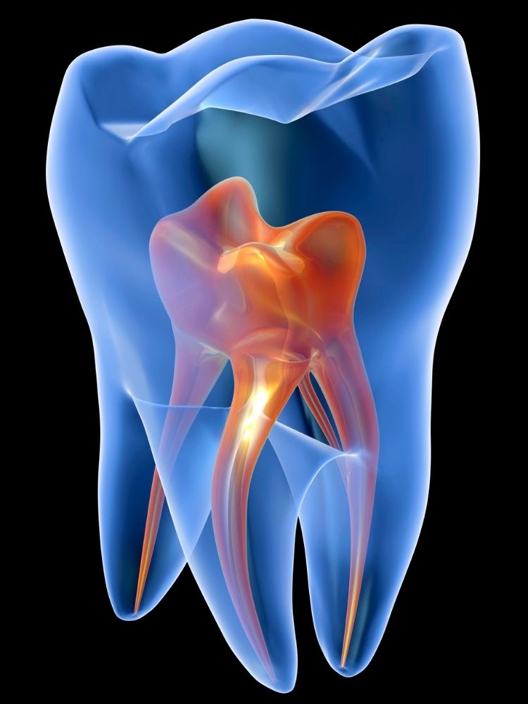 Root canal