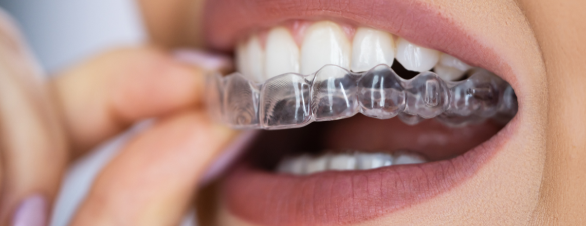 Invisalign Benefits