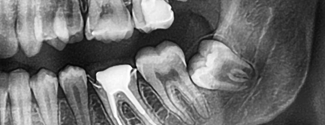 Learn wisdom teeth timing and what to expect